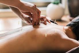 Image result for Acupuncture
