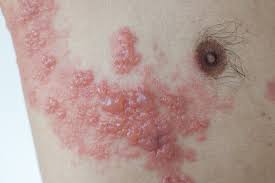 Image result for herpes zoster