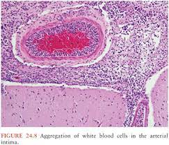 Meningitis is most commonly caused by infection (by bacteria, viruses, or fungi), although it can also be caused by bleeding into the meninges, cancer, diseases of the immune system, and an inflammatory response to certain types of chemotherapy or other chemical agents. Acute Bacterial Meningitis Oncohema Key