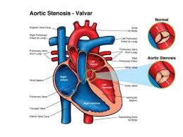 Image result for Left Ventricular Outflow Obstruction