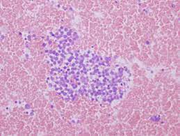 Merkel cell carcinoma (mcc) is a rare, highly aggressive skin cancer affecting older patients, and thought to arise from the cutaneous merkel cell, a neuroendocrine cell. Pathology Outlines Case Of The Week 414