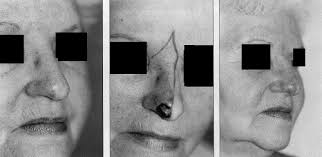 Basal cell carcinoma of the nose