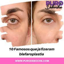 10 Famosos Que Ja Fizeram Blefaroplastia Puro Deboche
