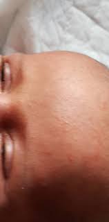 Al Bebe Se La Ha Puesto La Cara Llena De Granitos Acne Neonatal