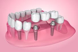 The Pros and Cons of Dental Implants - Saskatoon Smiles