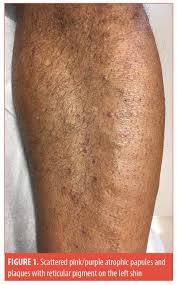 Download in under 30 seconds. Letter To The Editor Atrophic Lichen Planus Jcad The Journal Of Clinical And Aesthetic Dermatology