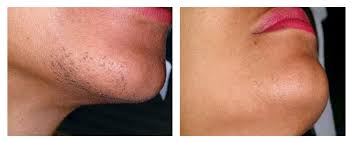 Here's what you need to know about laser hair removal, from the results to cost. Laser Hair Removal Ottawa Advanced Laser Clinic