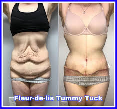 Details of a tummy tuck procedure; Facebook