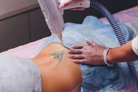 If you would like your program added or know of a program that should be included, please click here. Things To Consider When Choosing A Laser Tattoo Removal Clinic San Diego Dermatologist