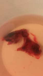 Decidua describes when the lining of the uterus undergoes changes from the influence of progesterone in preparation for pregnancy during the secretory phase of the menstrual cycle, dr. How Long After Decidual Bleeding Can You Take A Pregnancy Test Pregnancy Test Kit