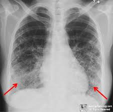 Learningradiology Scleroderma Lung Progressive Systemic Sclerosis Pulmonary Xray X Ray Student Medical Radiology Radiologic Educational Best Website Web Site Resource Tutorial Jpg Jpeg Image Imaging