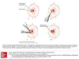 These occurs when a blood clot develops in a hemorrhoidal blood vessel causing. Excision Of The Thrombosed External Hemorrhoid A Ppt Download
