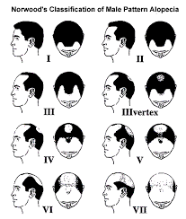 graft numbers hair transplant surgery bernstein medical