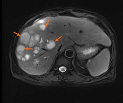 Image result for Liver Abscess