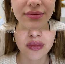 Free Laser Hair Removal Services in Melbourne for Models