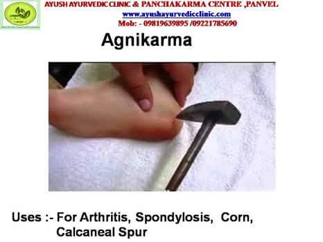 agnikarma treatment 20% off product image