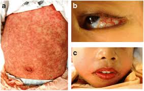 Residents and fellows contest rules | international ophthalmologists contest rules. Steven Johnson Syndrome Drug Or Bug Springerlink