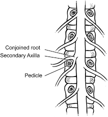Under the listing for nerve root compression (listing 1.04a), the ssa specifies the symptoms and severity required for nerve root compression of any kind to qualify as a disability. Conjoined Nerve Roots Of The Lumbar Spine The Spine Journal