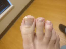 Go beyond ordinary nail art with polishing toenails from alibaba.com. White Chalky Toenails From Nail Polish Causes Home Remedies
