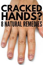 Severely Cracked Hands 8 Tips Remedies For Fast Relief Dry Cracked Hands Cracked Hands Extremely Dry Hands