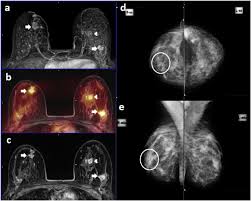 An mri for a breast cancer evaluation is currently the most common reason to have a breast mri. Simultaneous Whole Body 18f Fdg Pet Mri In Primary Staging Of Breast Cancer A Pilot Study European Journal Of Radiology