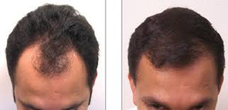 Men's layers with taper sides. Hair Transplant Cost Kurtzman Plastic Surgery