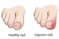 Ingrown Toenail - Is it Time To See a Podiatrist?