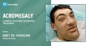 Image result for Acromegaly
