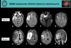 Limbic encephalitis, mca ischaemia, tumours, effects of seizures) hyperintense t2 signal in the medial temporal lobes, inferior frontal lobes and insula basal ganglia are usually spared Epos Trade
