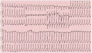 What does svt stand for? St Segment Elevation And Depressions In Supraventricular Tachycardia Without Coronary Artery Disease