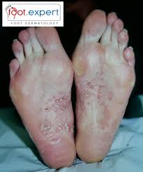 Image result for pompholyx soles of feet
