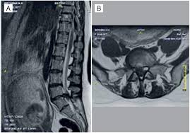 For those with herniated discs, especially in the lumbar spine, sleeping in the fetal position is often recommended. Scielo Brasil Surgical Treatment Of Lumbar Disc Herniation In Pregnant Women Report Of Two Cases And A Systematic Review Surgical Treatment Of Lumbar Disc Herniation In Pregnant Women Report Of