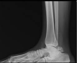 Os Trigonum Podiatry Orthopedics Physical Therapy