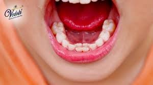 Management Of Supernumerary Teeth. - Abstract - Europe Pmc