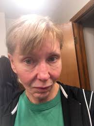 The Tyndall effect under eyes from filler? (Photo)