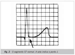 O termo enfarte do miocárdio deve ser usado quando há evidência. Scielo Brasil Analise De Registros Eletrocardiograficos Associados Ao Infarto Agudo Do Miocardio Analise De Registros Eletrocardiograficos Associados Ao Infarto Agudo Do Miocardio