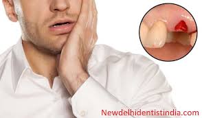 How is dry socket treated? 5 Significant Faq S About Dry Socket That You Need To Know Dental Blog New Delhi Dentist India