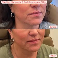 Smooth fine lines, marionette lines, and oral commissures with filler! 💫  Look at these amazing results! 👩🏼‍⚕️ Injector: Julia Lazarus 💉  Treatment: fine line, marionette & oral commissure filler 🚫 Avoid: Invasive