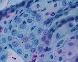 Benign mesothelioma is rarer than the malignant form, leading to a limited. A Sheet Of Benign Mesothelial Cells Arranged In A Mosaic Pattern With Download Scientific Diagram