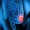 There is a good chance you have either heard of, suffer from, or know someone who suffers from ibs. 1