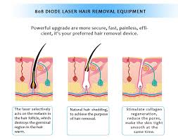 That means you can spend more time living and less time with a razor in your hand. Why Should You Choose Laser Hair Removal