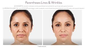 But if they're deep, they can instantly age you. Juvederm Restylane In Westport Facial Fillers New Beauty Wellness