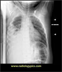 Pleural effusion symptoms include shortness of breath or trouble breathing, chest pain, cough, fever, or chills. Solution To Unknown Case 23 Empyema Loculated Pleural Effusion Radiologypics Com