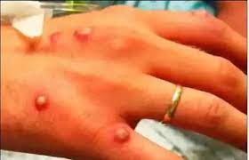 While officials say that the risk is low due to the air. Drbmjgojl9qpam