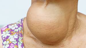 Image result for Goiter