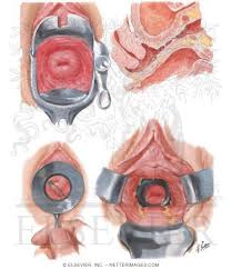 Image result for Vaginitis