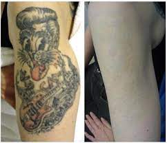 It is the best in the market which means you will get your tattoo removed in fewer treatments. Tattoo Removal In Phoenix Scottsdale Az Suddenly Slimmer Med Spa