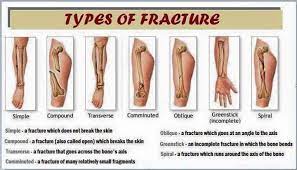 Types Of Fractures Types Of Fractures Simple Fracture Oblique Fracture
