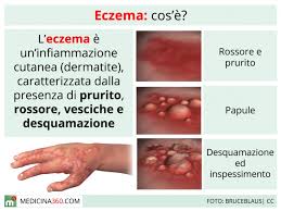 Image result for Eczema nummulare