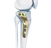 TOMOFIX Osteotomy System | Products | DePuy Synthes